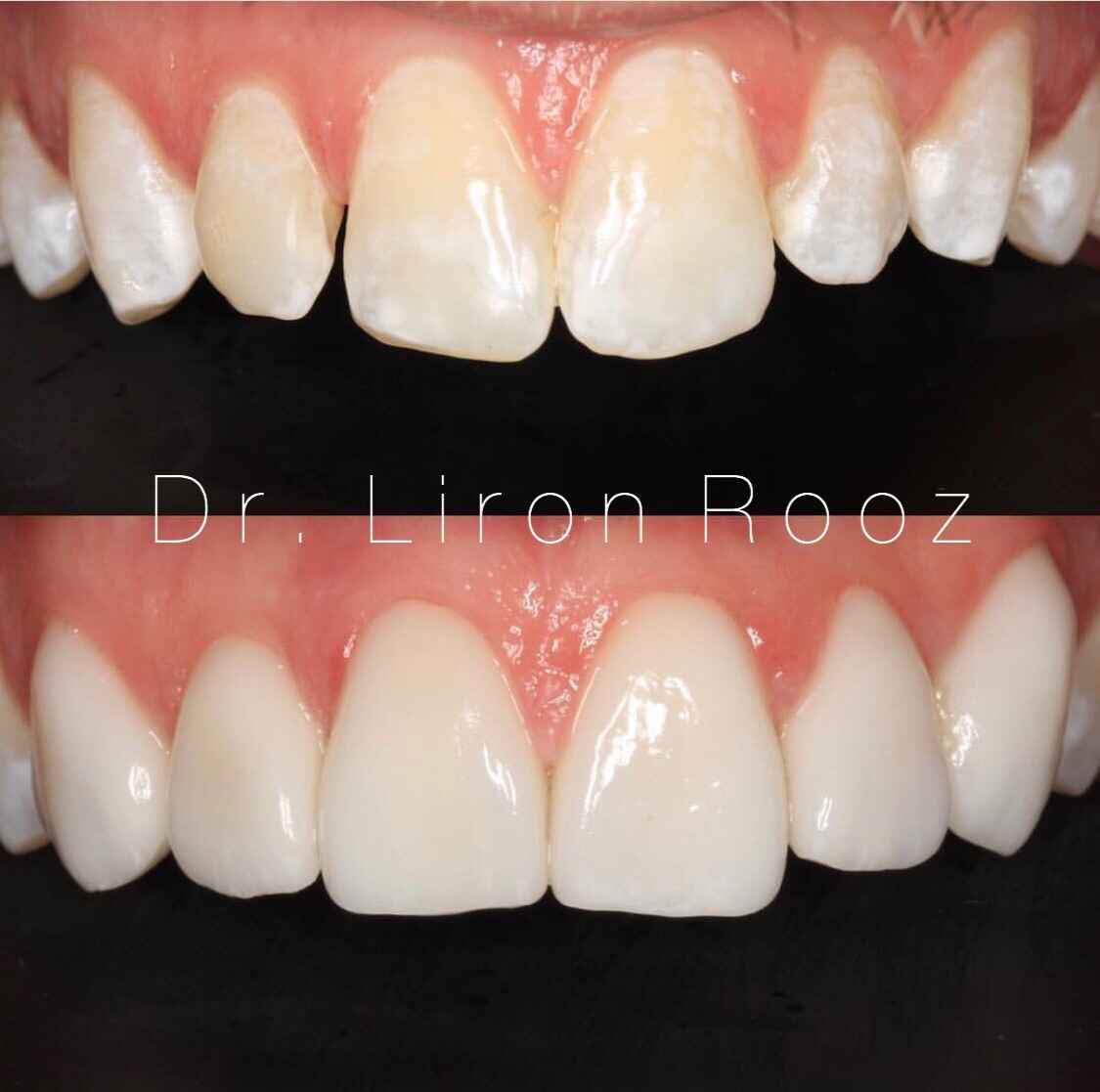Bleached-white-veneers