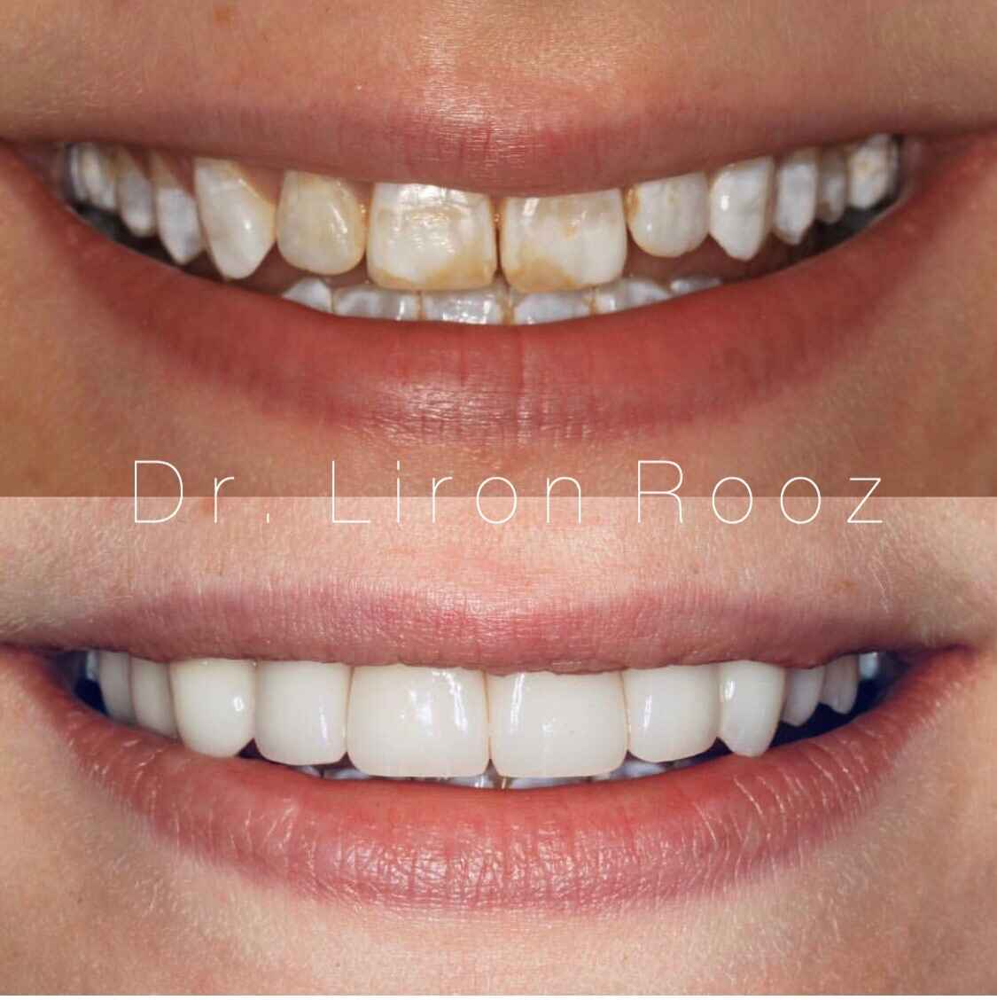 Full-Upper-Veneers