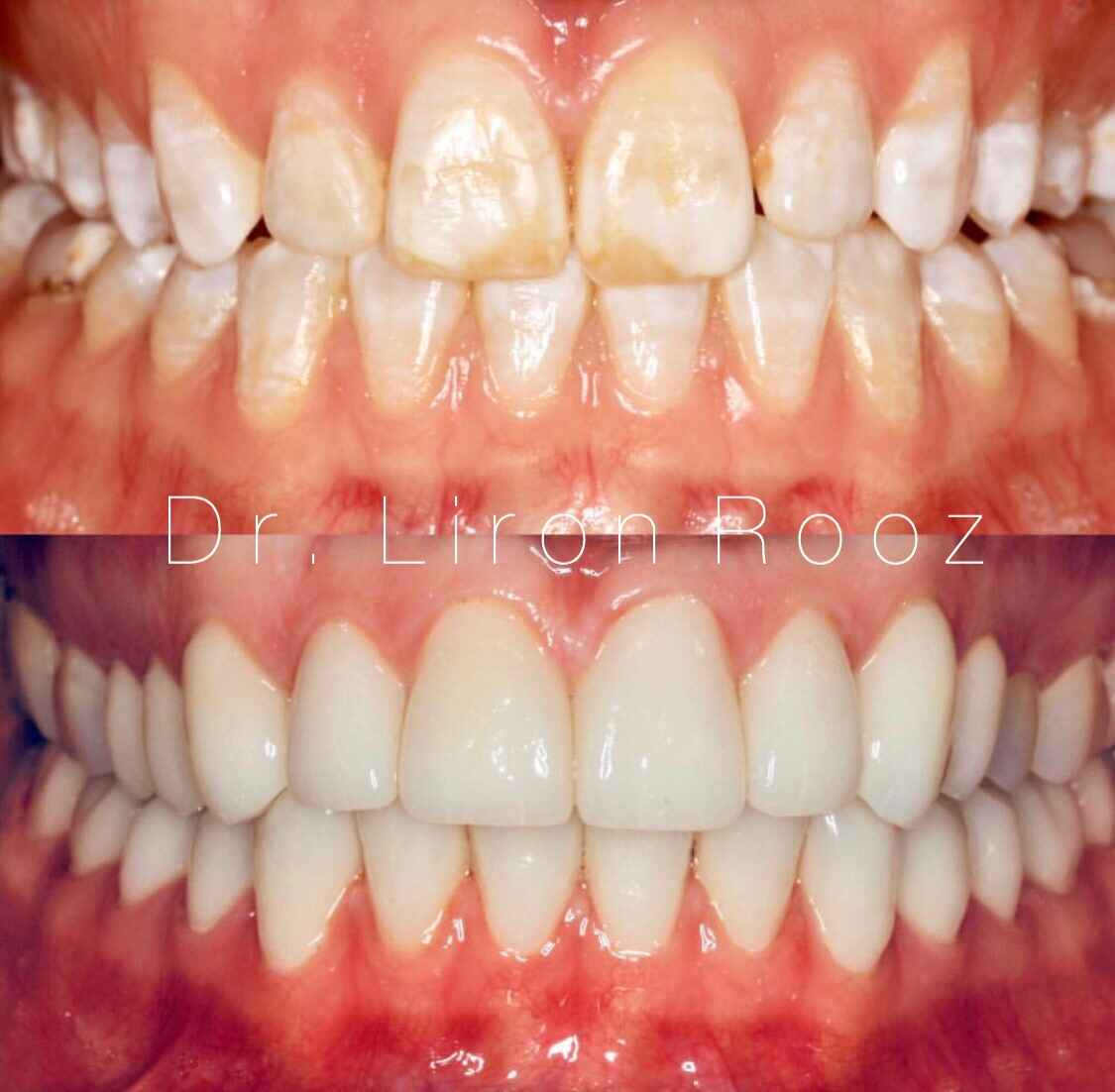Full-mouth-veneers