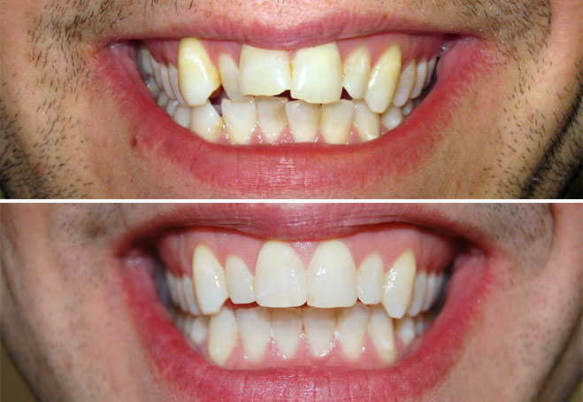 Invisalign-ChrisHill