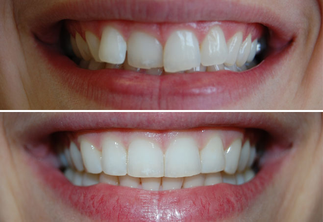 Invisalign_Amanda