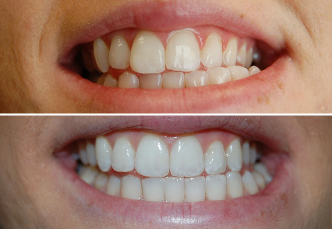 Invisalign_Barbara