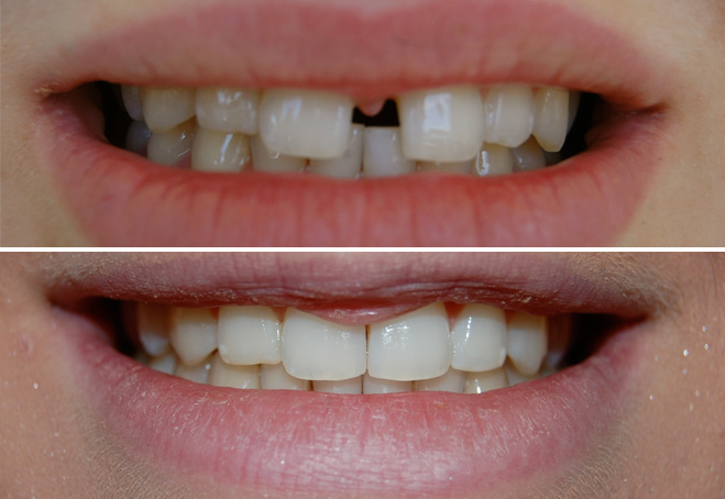 Invisalign_Emily