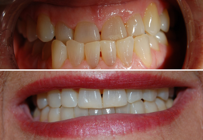 Invisalign_Joanne