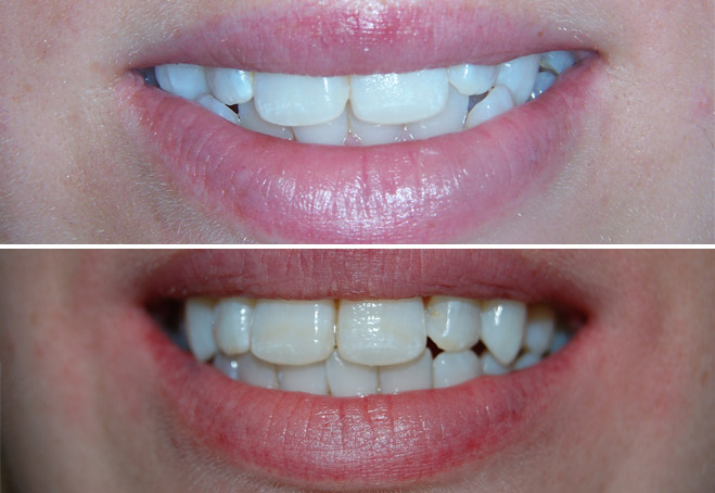 Invisalign_Karly