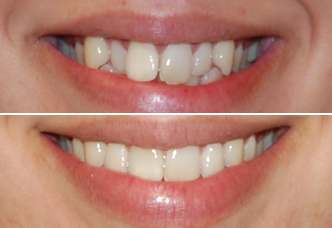 Invisalign_Kim