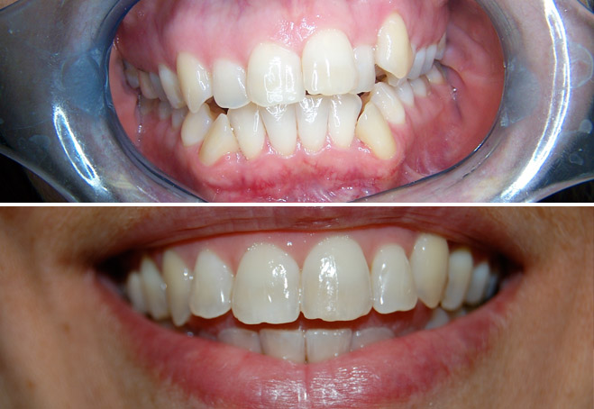 Invisalign_Rita