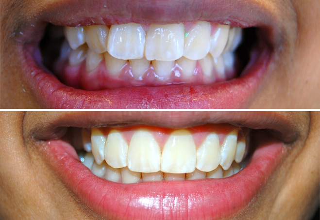 Invisalign_Sonita