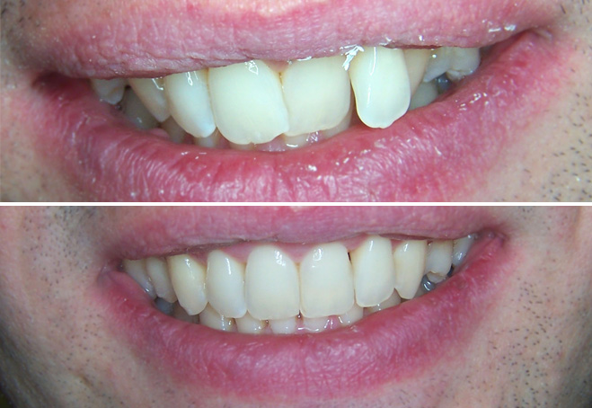 Invisalign_Tim
