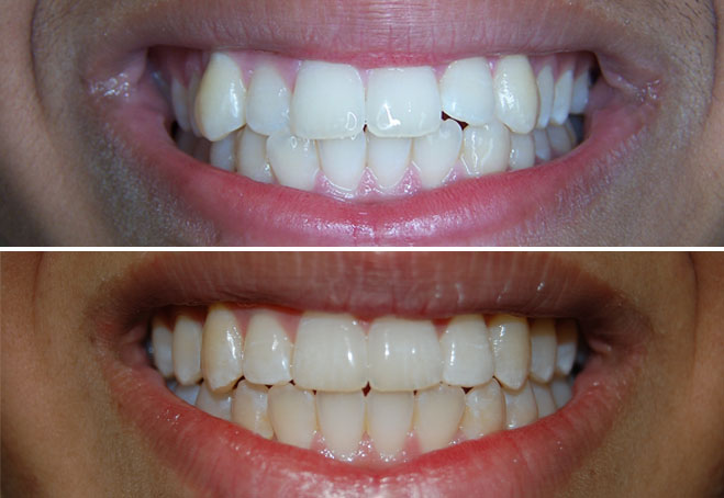 Invisalign_Viraj