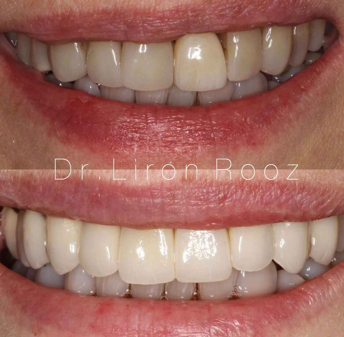 Old-veneers-replacement