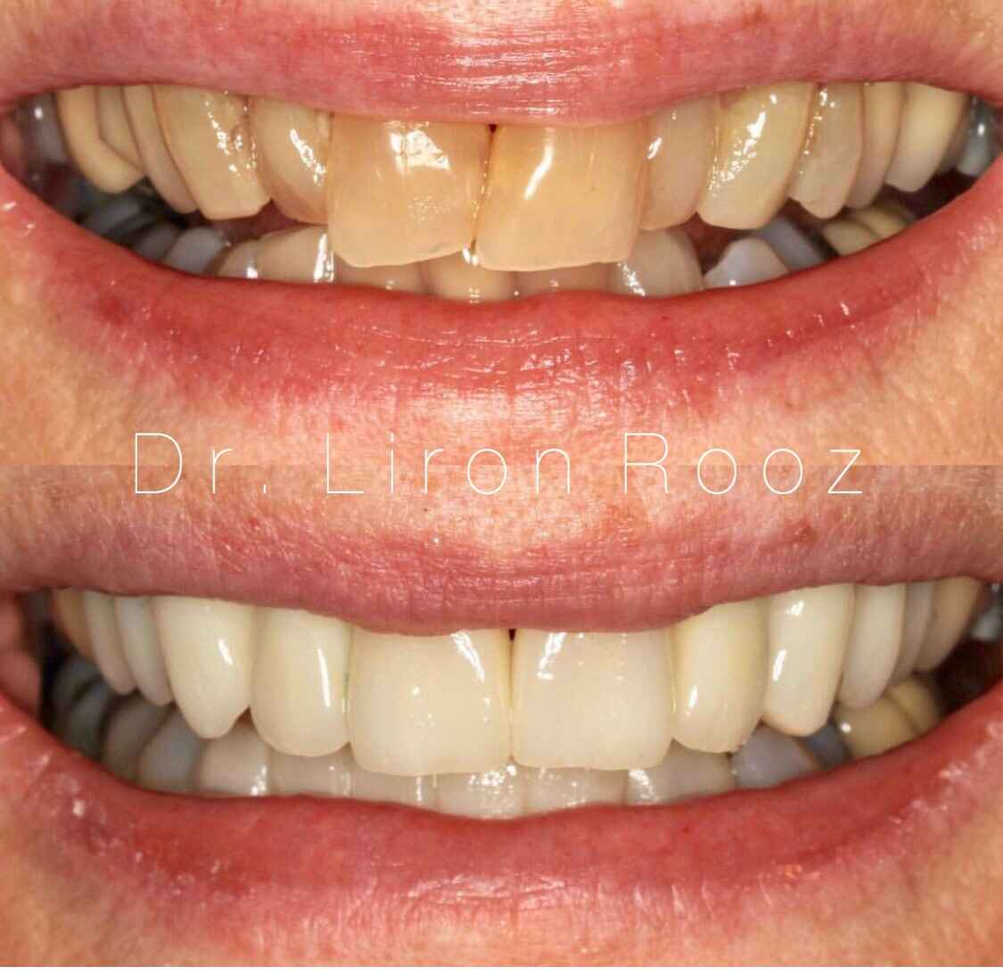 Upper-veneers