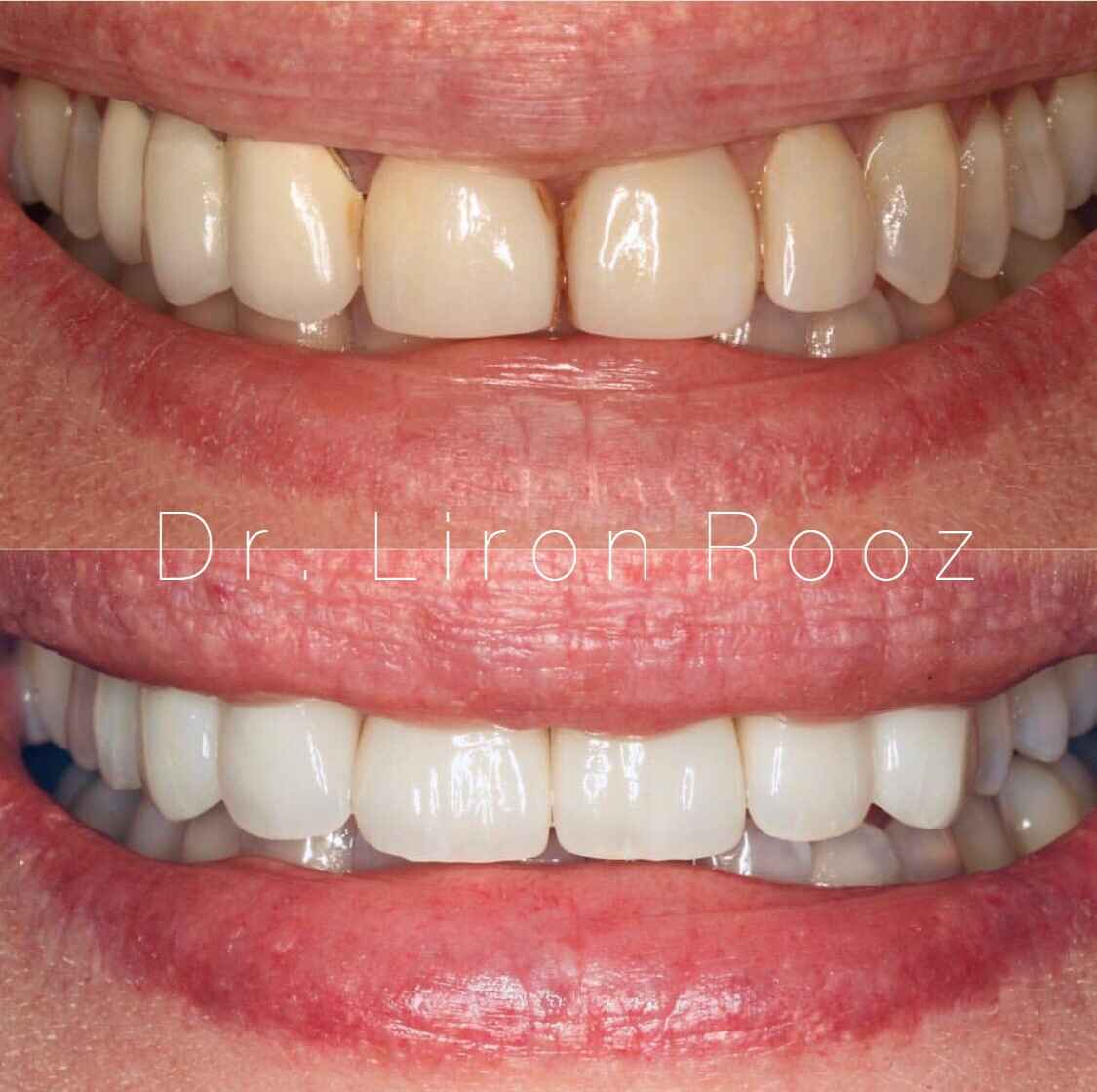 Veneers-1