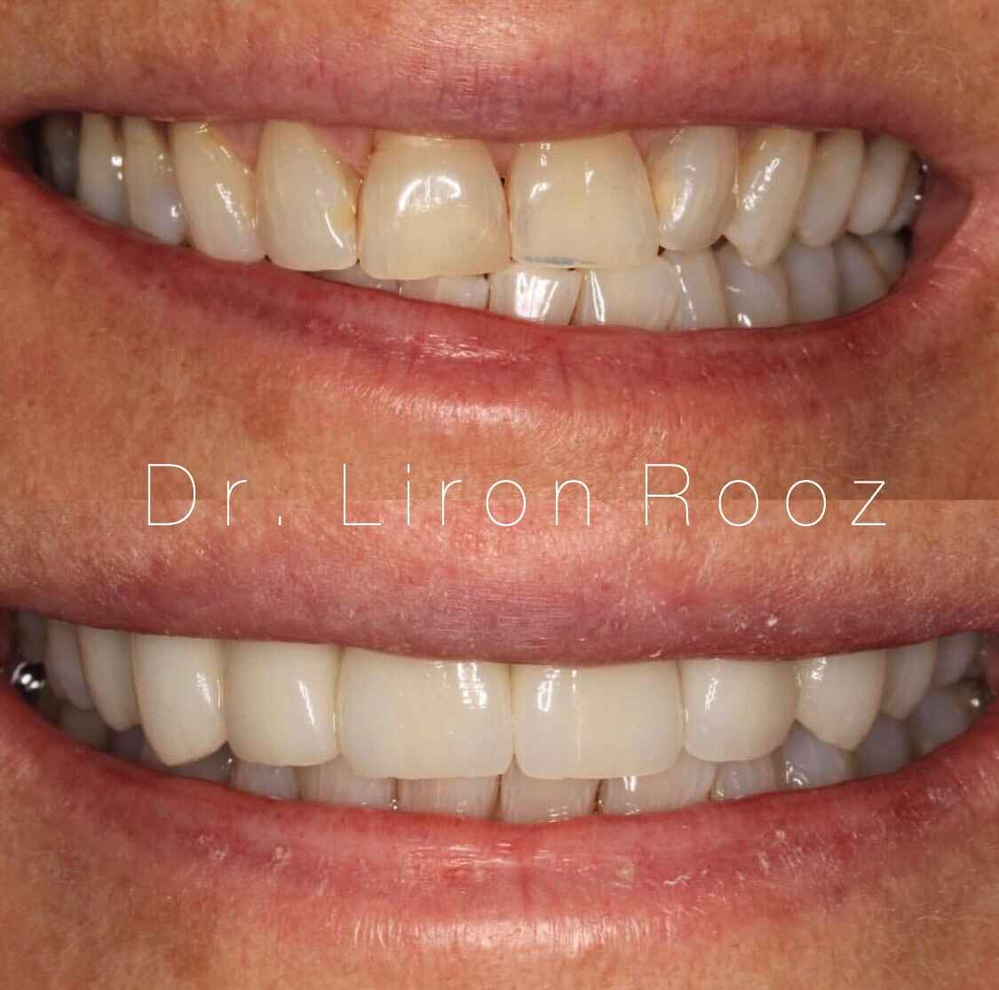 Veneers-2