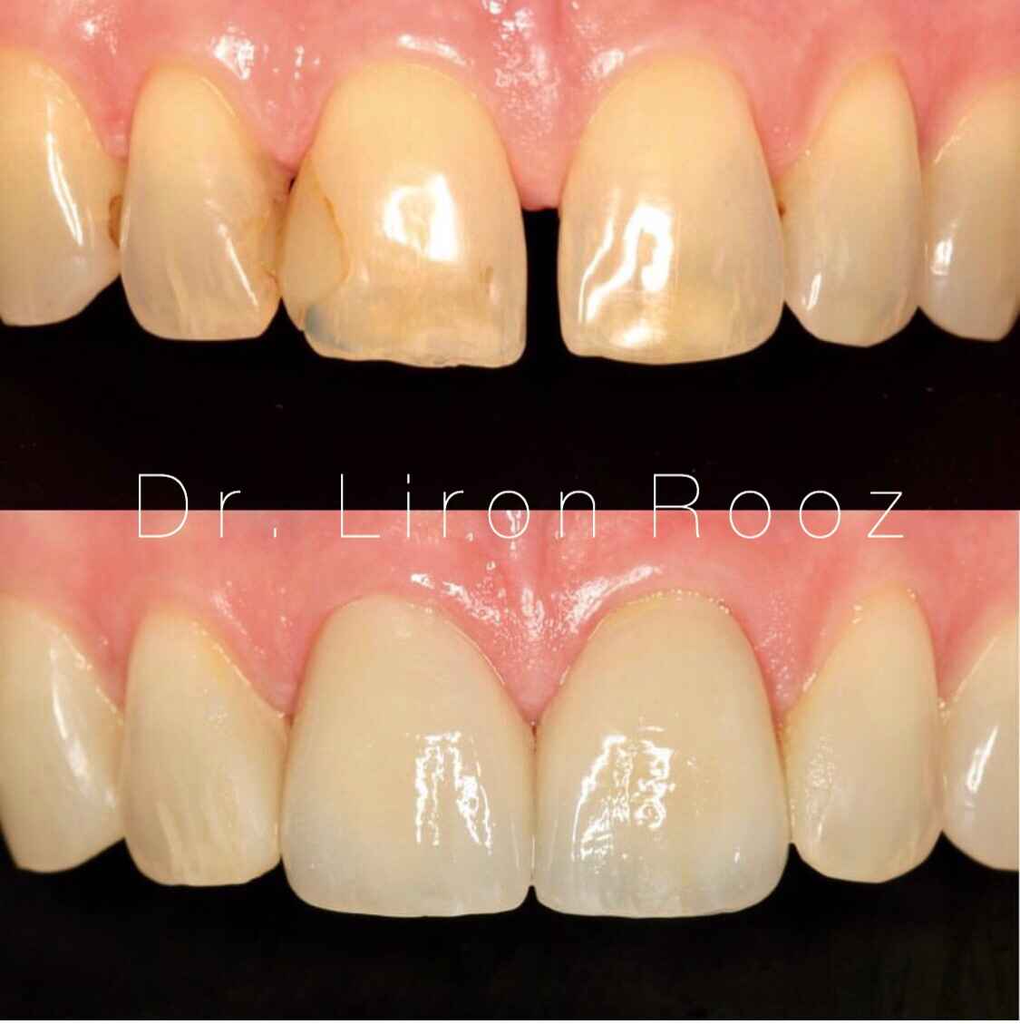 Veneers-and-Bonding