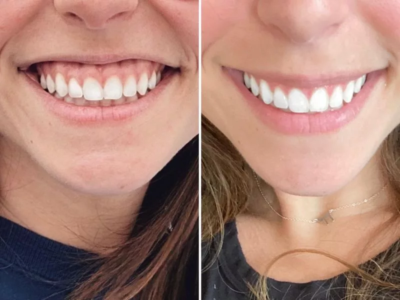 Treating a Gummy Smile