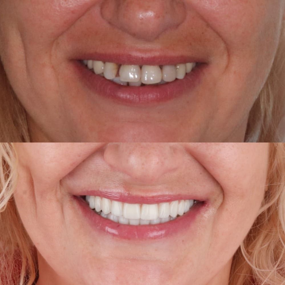 All-on-4 Dental Implants