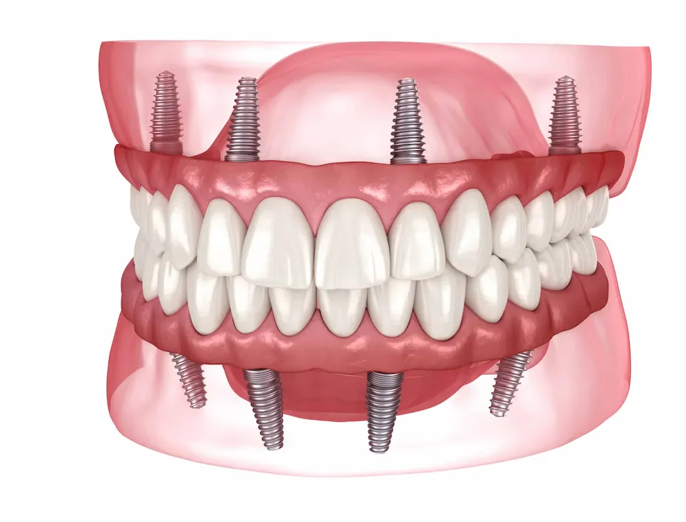 Benefits of Dental Implants