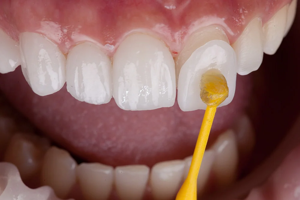 Benefits of Veneers